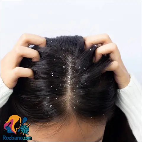 روش های خانگی درمان شوره سر