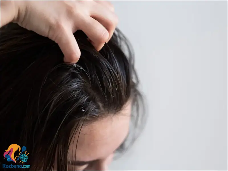 آموزش درمان شوره سر با روش های خانگی و شامپوهای موثر