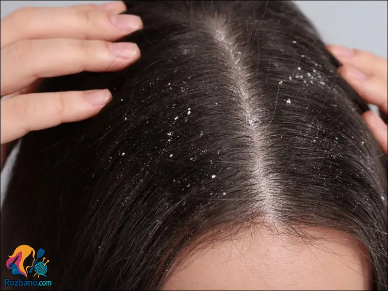 علت و درمان قطعی شوره سر در خانه