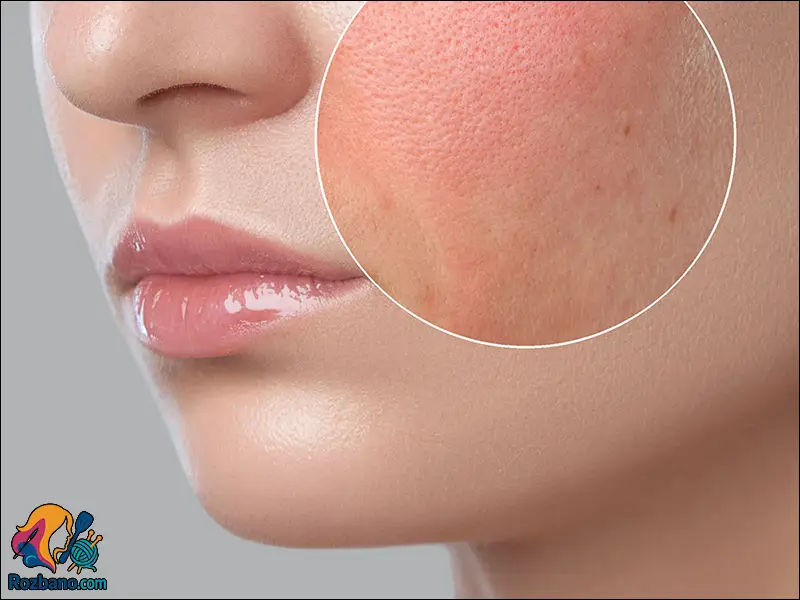 حفظ شادابی پوست در ماه رمضان - چرا پوست در ماه رمضان خشک و کدر می شود؟