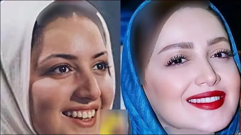 عکس های شیلا خداداد قبل و بعد از عمل بینی