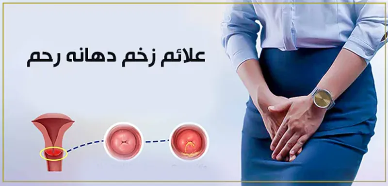علائم زخم دهانه رحم و راهکارهای پیشگیری و درمان زخم دهانه رحم
