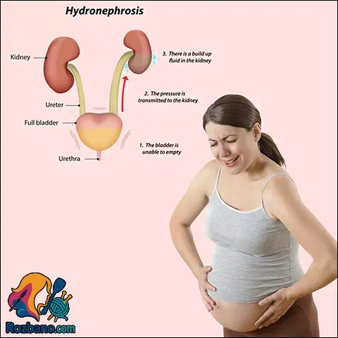 پیشگیری از عفونت های کلیه و مثانه در دوران بارداری