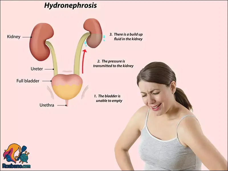 علائم و منشا عفونت های کلیه و مثانه در زنان باردار و روش های درمان