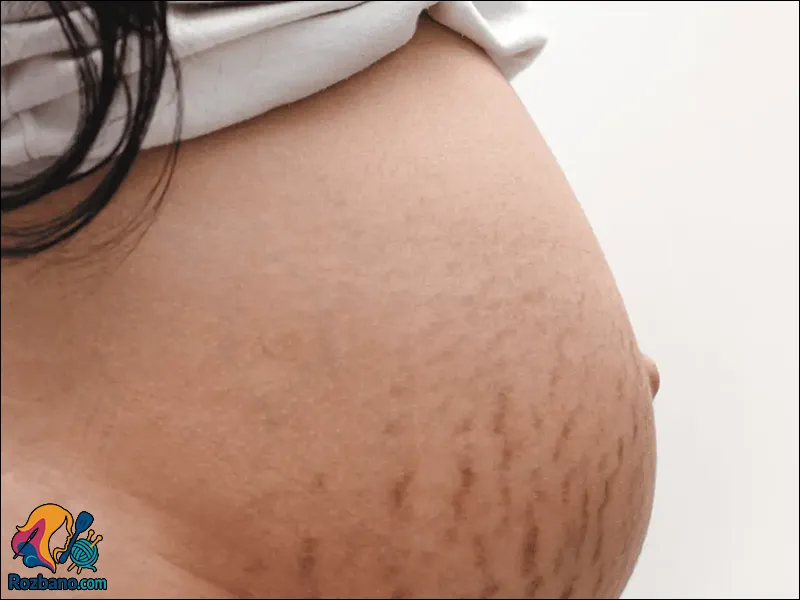 تغییرات پوست در دوران بارداری و مشکلات پوستی رایج