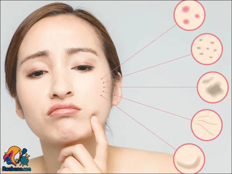 انواع مشکلات پوستی در دوران بارداری و درمان آن