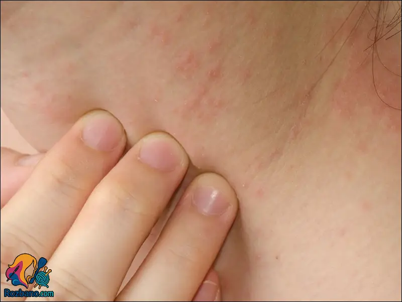 6 عامل تخریب کننده پوست که باید بشناسید