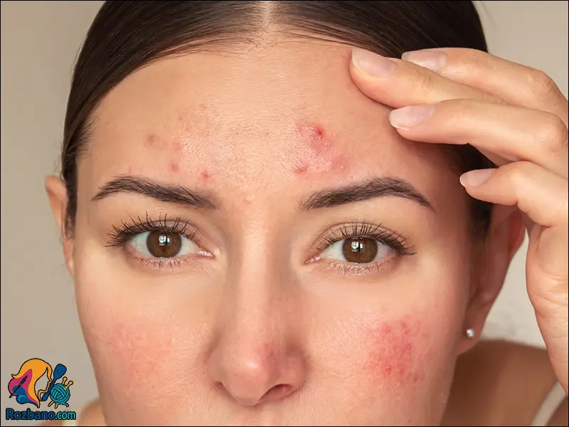 استرس و نقش آن در عوامل تخریب کننده پوست