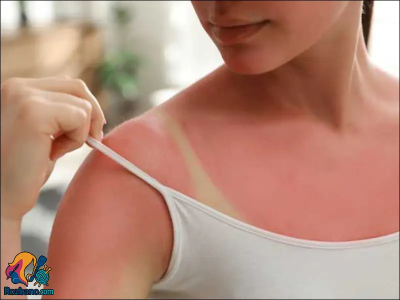 آفتاب سوختگی و خطرات آن و استفاده از کرم ضد آفتاب