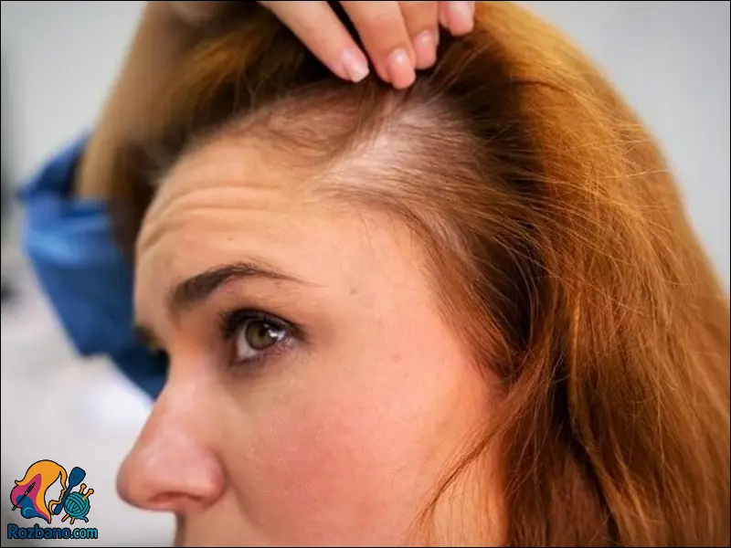 خوراکی برای درمان ریزش مو و افزایش رشد طبیعی مو