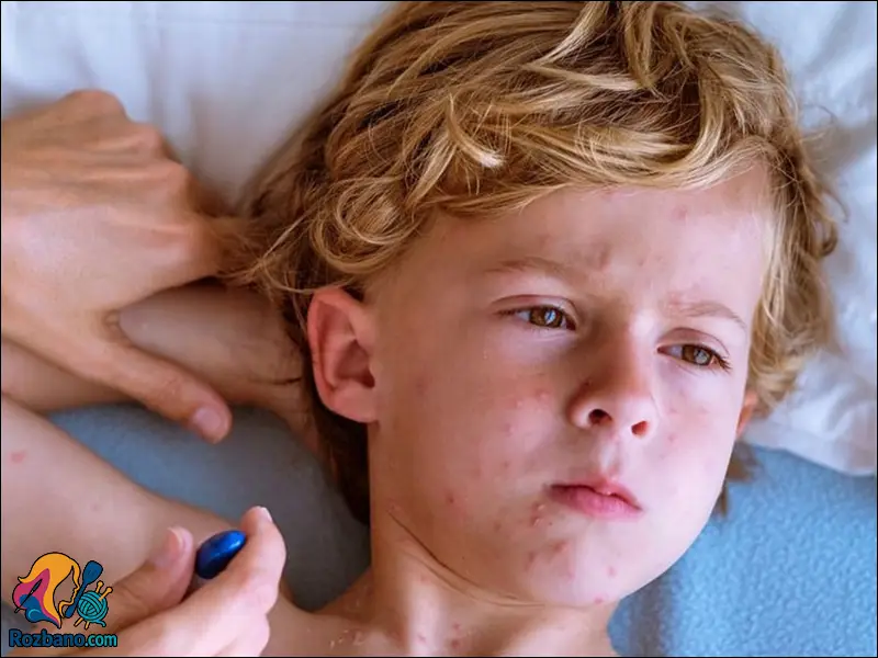 درمان سرخجه با داروهای گیاهی در طب سنتی