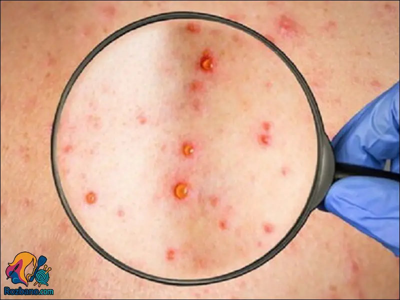 درمان سرخجه در خانه با گیاهان دارویی و تغذیه مناسب