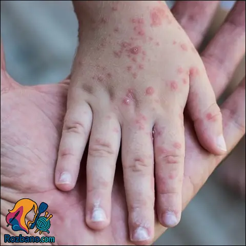 درمان سرخجه با داروهای گیاهی و روش های طبیعی موثر