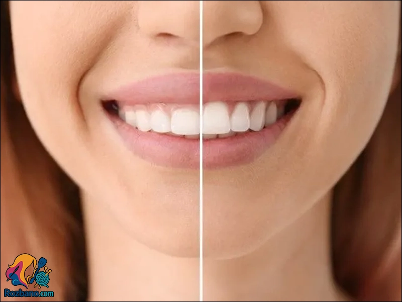 اصلاح لبخند لثه ای به کمک لیفت لثه