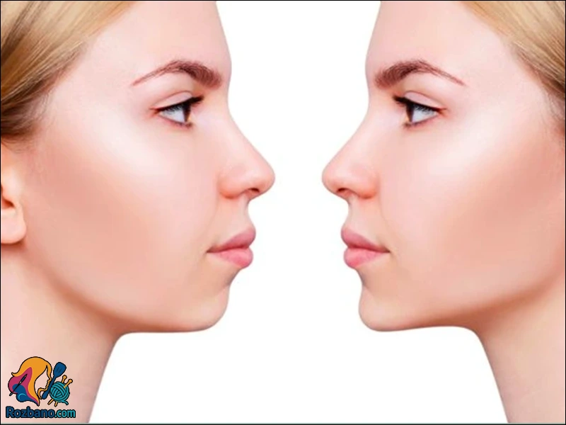 جراحی فک برای بهبود لبخند
