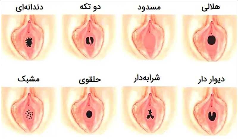 انواع پرده بکارت با علائم پارگی و تشخیص پزشک