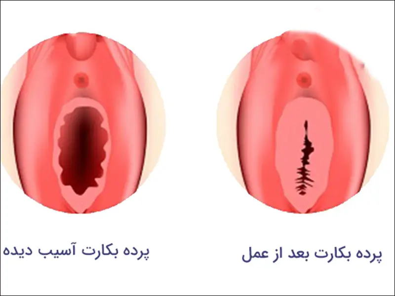 راهنمای پزشکی تشخیص انواع پرده بکارت و سلامت هایمن