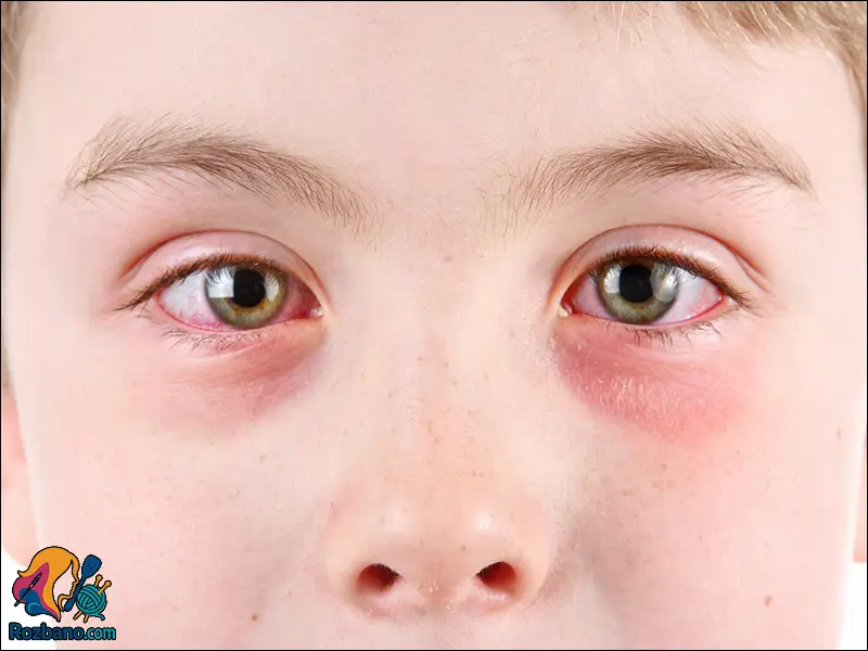 علائم بیماری های چشم کودکان - عفونت های چشمی در کودکان