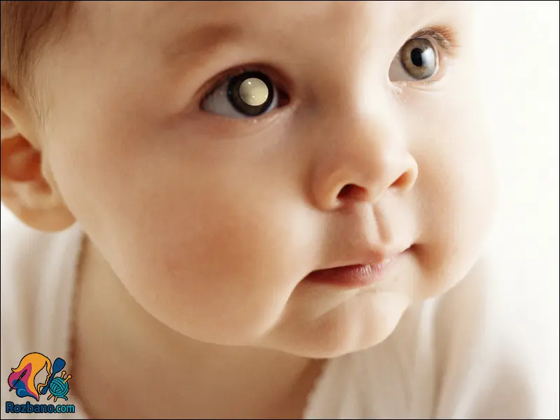 علائم بیماری های چشم کودکان - سفید شدن قرنیه چشم