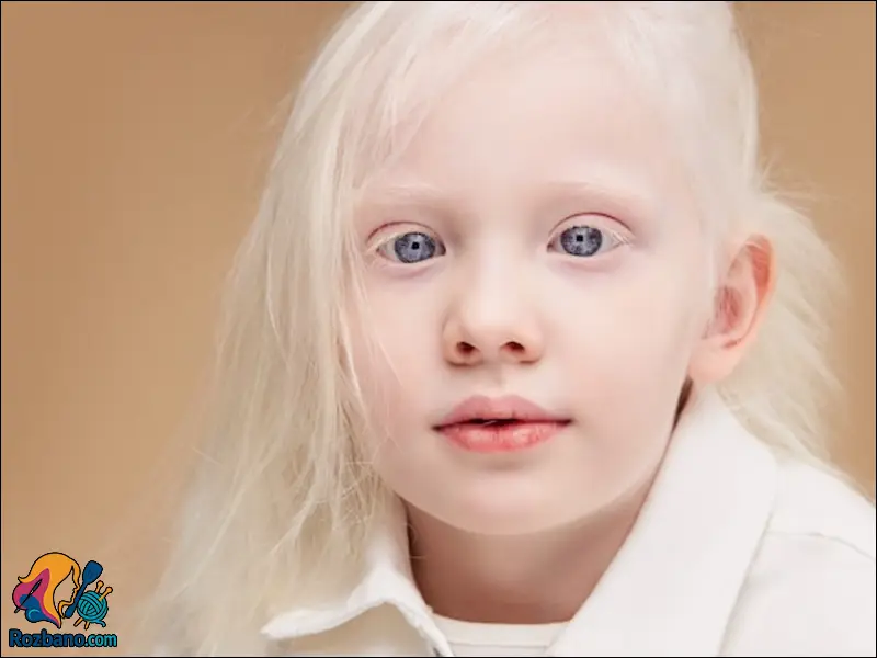 علائم بیماری های چشم کودکان - اختلالات مادرزادی مانند آلبینیسم