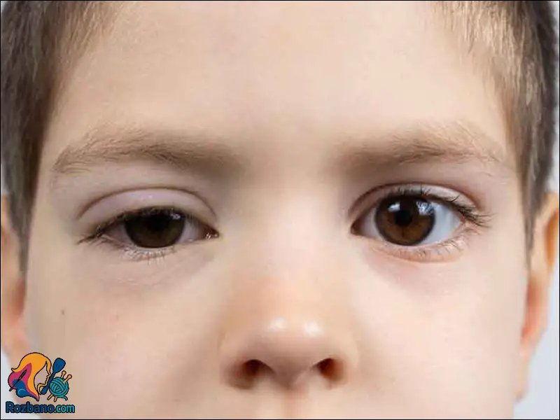 علائم بیماری های چشم کودکان - نامتقارن بودن چشم ها و افتادگی پلک