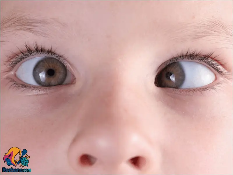 علائم بیماری های چشم کودکان - لرزش مردمک و لوچی