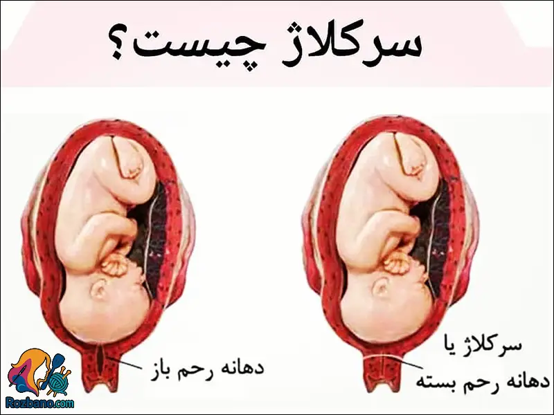 سركلاژ در بارداری و نحوه انجام آن