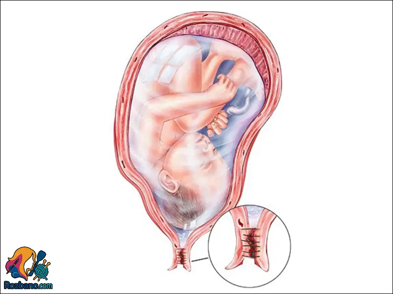 سركلاژ در بارداری چیست و چه زمانی انجام می شود