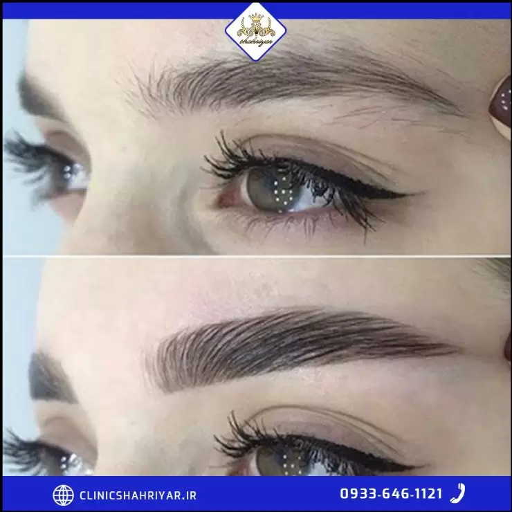 https://up.rozbano.com/view/3778247/Eyebrow%20transplantation-01.webp