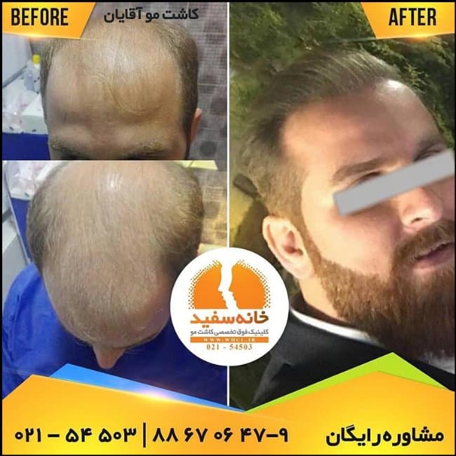 https://up.rozbano.com/view/3273566/How%20is%20hair%20transplantation%20done%20by%20FIT%20method-02.jpg