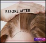 کاشت مو به روش FIT چگونه انجام می شود؟ - How20is20hair20transplantation20done20by20FIT20method 03