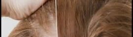 How20is20hair20transplantation20done20by20FIT20method-03
