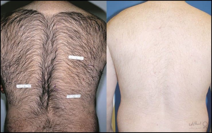 https://up.rozbano.com/view/2967324/Laser%20hair%20loss-01.jpg