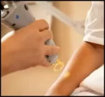 لیزر موهای زائد چگونه انجام میشود؟ پایان نگرانی شما - Laser20hair20removal 02