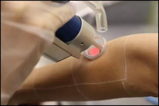 آیا لیزر موهای زائد باعث نازایی میشود؟ شایعه یا واقعیت؟