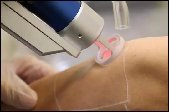 آیا لیزر موهای زائد باعث نازایی میشود؟ شایعه یا واقعیت؟