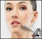 آموزش ساخت ماسک خانگی ضدجوش - Making20a20homemade20anti acne20mask 01