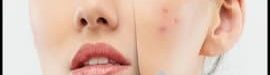 Making20a20homemade20anti-acne20mask-01