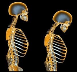 پوکی استخوان و راه های درمان آن - Osteoporosis20and20its20treatment20methods 02