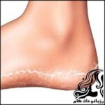 درمان های خانگی ترک کف پا - rozbano 107 3
