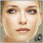 نسخه پیچی برای خلاصی از کک و مک پوستی - rozbano 17