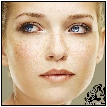 نسخه پیچی برای خلاصی از کک و مک پوستی - rozbano 17