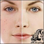 پوشاندن لک های روی پوست بوسیله آرایش - rozbano 207 1 1