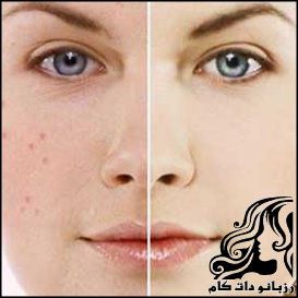 پوشاندن لک های روی پوست بوسیله آرایش - rozbano 207 1 1