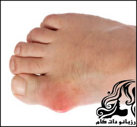 راهکارهای طب سنتی برای درمان نقرس - rozbano 339 2