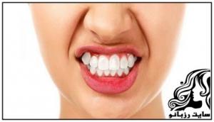 عوامل و علل دندان قروچه - rozbano 86a