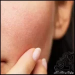 بارداری و تغییرات پوستی این دوران - this20skin20changes20during20pregnancy 02