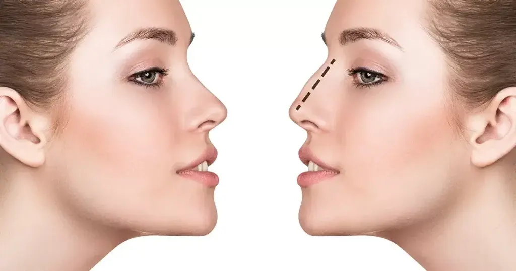 بهترین جراحی بینی در ایلام