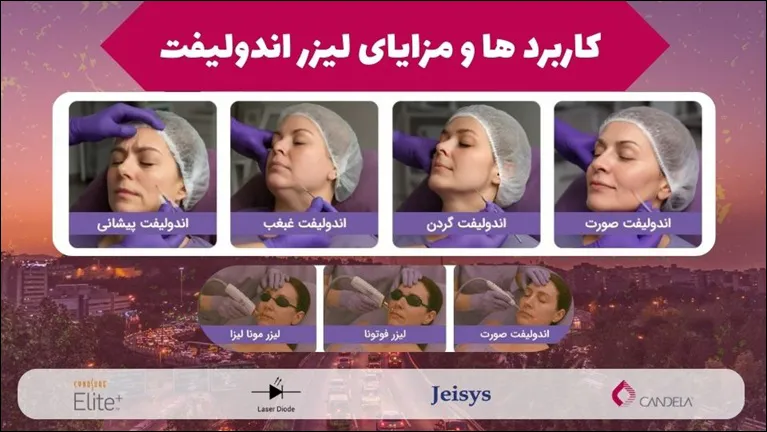 بهترین کلینیک لیزر سعادت آباد و تهران - لیزر اندولیفت در کلینیک پامچال