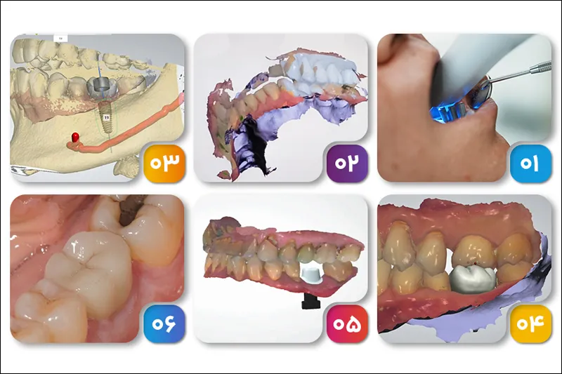 روش انجام ایمپلنت دیجیتال